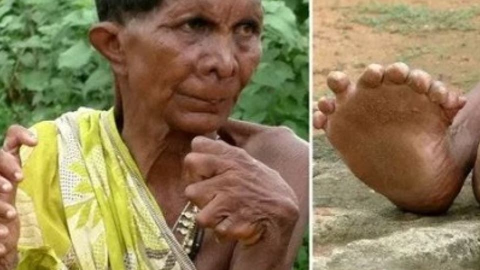 اعتقدوها ساحرة ..معاناة هندية بـ31 إصبع!