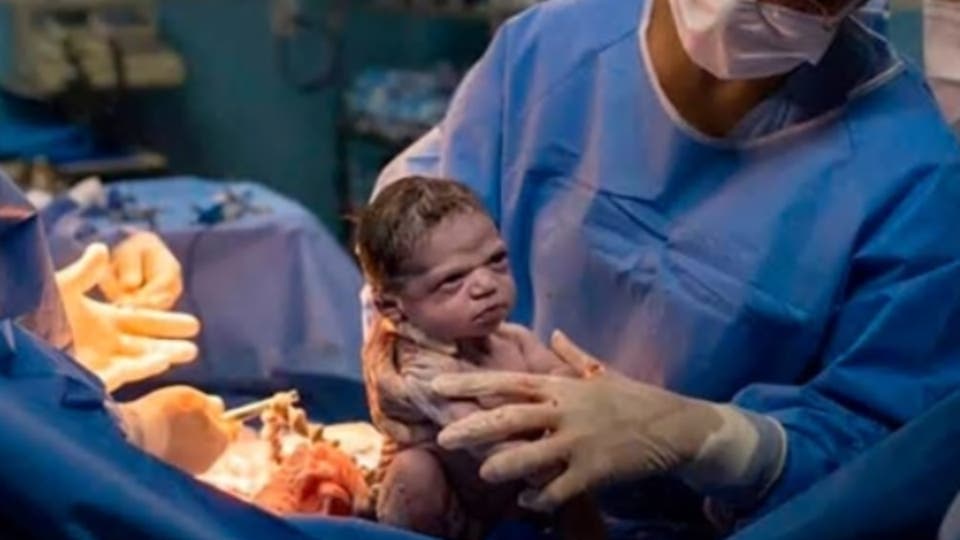 طفلة ولدت “عاتبة” على الطبيب الذي أخرجها إلى العالم