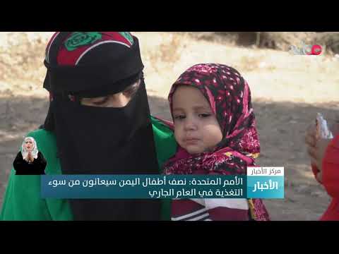 الأمم المتحدة: نصف أطفال اليمن سيعانون من سوء التغذية في العام الجاري