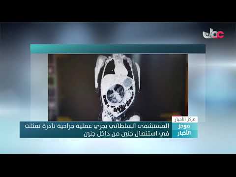 المستشفى السلطاني يجري عملية جراحية نادرة تمثلت في استئصال جنين من داخل جنين