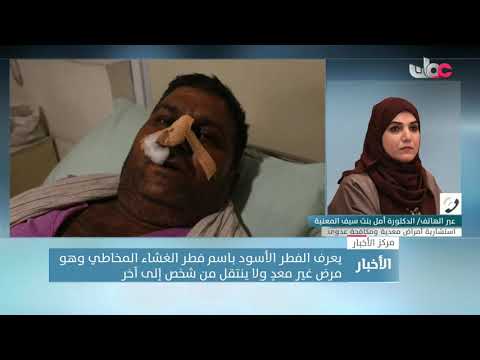 د. أمل بنت سيف المعنية: الفطر الأسود ليس مرضا جديدا والإصابة به ترتبط بالمناعة الضعيفة