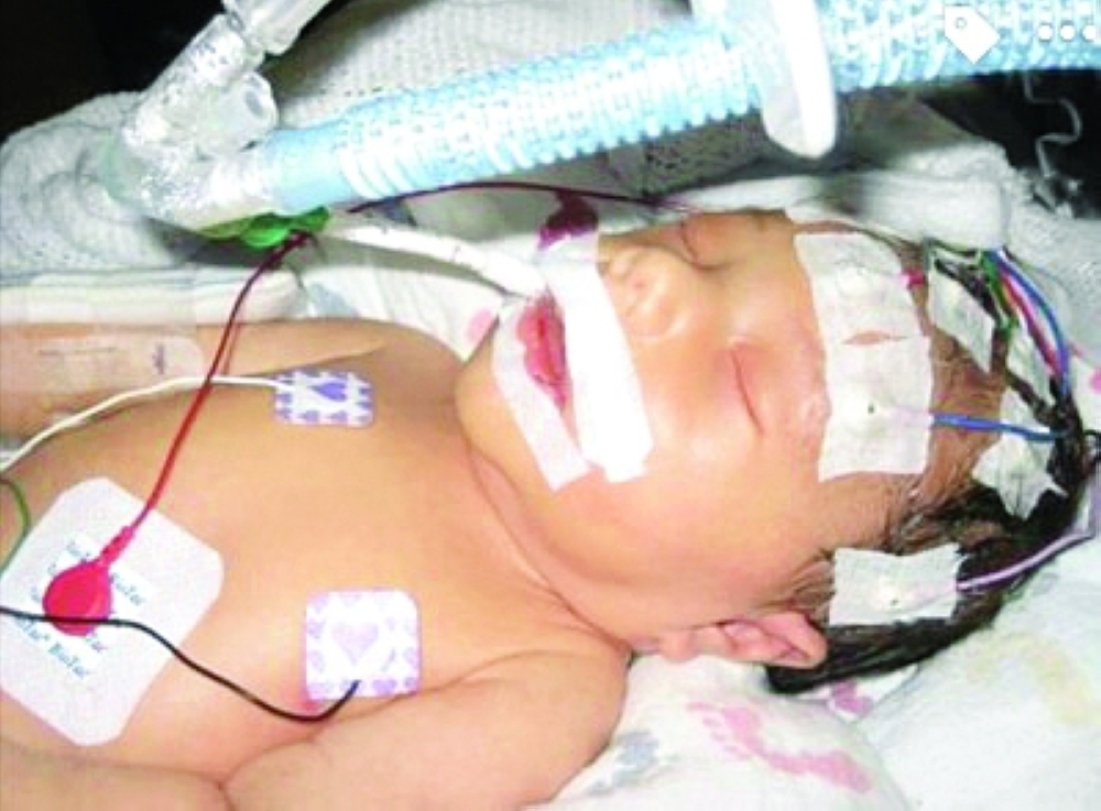 ارتفاع جلايسين الدم.. مرض وراثي نادر يهدد حديثي الولادة