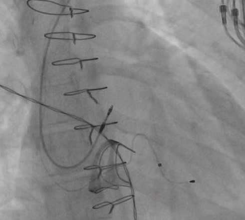 فريقٌ طبيٌّ متخصّصٌ ينجحُ في إجراء زراعة مُعقّدة لجهاز مُنظم لضربات القلب