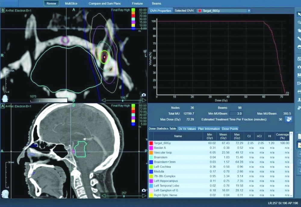 إجراء أول عملية جراحة إشعاعية لعلاج العصب الدماغي