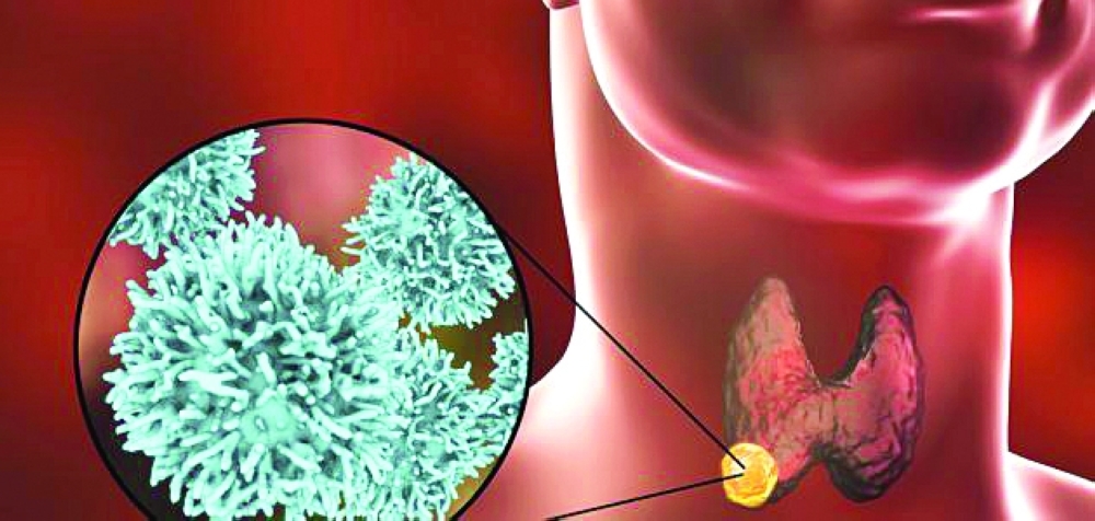 دراسة تؤكد ارتفاع التشخيص العام لسرطان الغدة الدرقية بين العمانيين