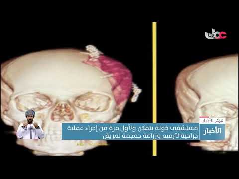مستشفى خولة يتمكن ولأول مرة من إجراء عملية جراحية لترميم وزراعة جمجمة لمريض