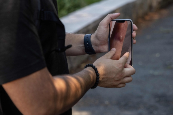 UAE reports 3 new cases of monkeypox