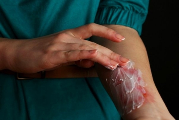 GCC bans the use of toothpaste for burns