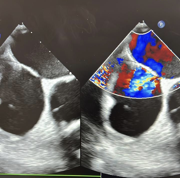فريق طبي في مستشفى جامعة السلطان قابوس أجرى عملية ناجحة لحالة نادرة