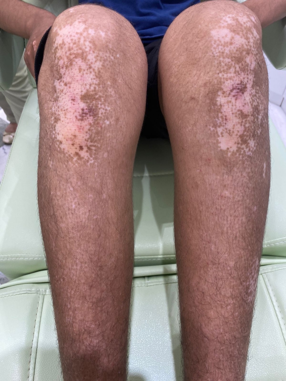 طبيبة أمراض جلدية: 3 % نسبة انتشار«البهاق ».. والمشاكل النفسية تعمق الإصابة